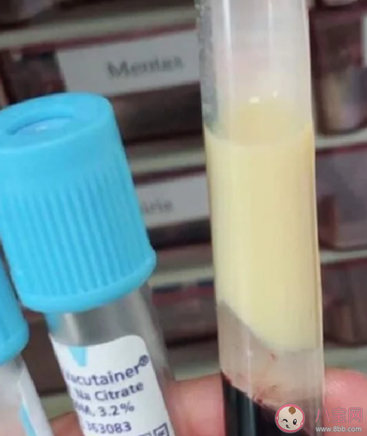 血液为什么会变成白色 哪些人更容易出现牛奶血