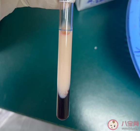 血液为什么会变成白色 哪些人更容易出现牛奶血