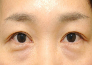 眼袋会遗传吗 如何科学改善眼袋