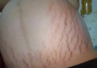 女子花2万修复妊娠纹无效起诉退款 妊娠纹后期能被修复吗