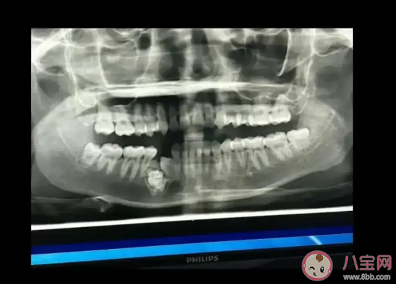 牙瘤的发病原因是什么 牙瘤严重吗