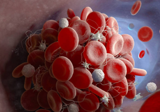 如何预防静脉血栓形成 哪些人是血栓形成的高危人群