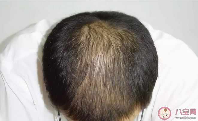 头顶脱发的人冠心病风险高吗 哪些征兆警惕冠心病 头顶脱发的人冠心病风险高吗 哪些征兆警惕冠心病