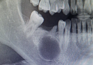 牙瘤会癌变吗 为什么会产生牙瘤