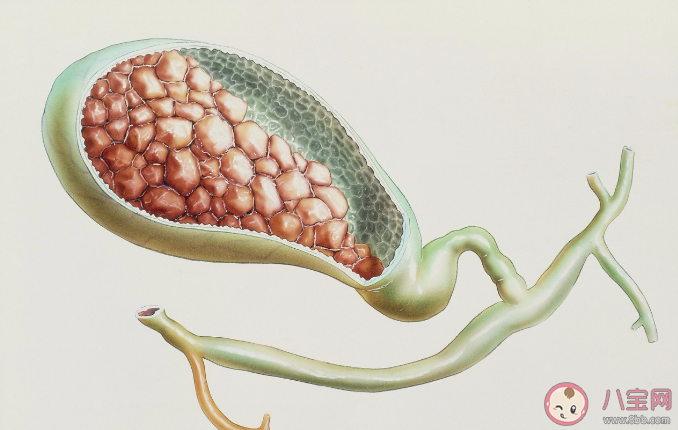 胆囊结石发病率越来越高吗 如何预防胆囊结石 胆囊结石发病率越来越高吗 如何预防胆囊结石