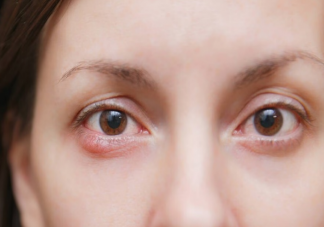 为什么电脑和手机看久了会得斜视 哪些表现可能是真斜视