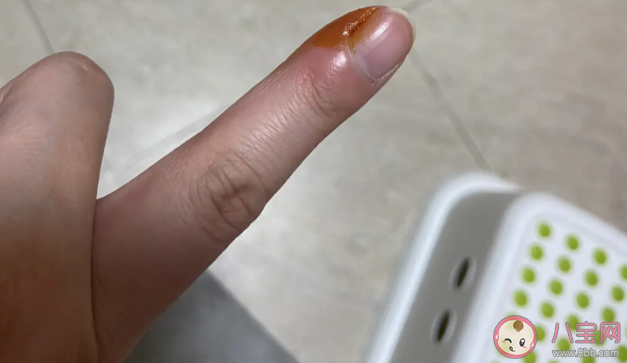 倒刺为什么不能随便拔 手指上为什么会长倒刺 倒刺为什么不能随便拔 手指上为什么会长倒刺