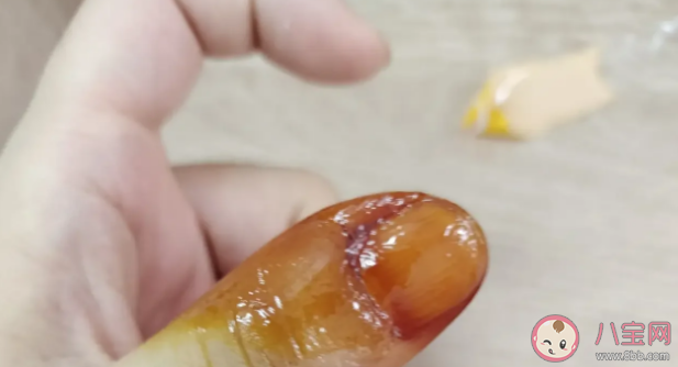 倒刺为什么不能随便拔 手指上为什么会长倒刺 倒刺为什么不能随便拔 手指上为什么会长倒刺