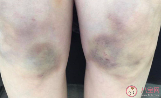 为什么你身上总有淤青 淤青应该怎么消除 为什么你身上总有淤青 淤青应该怎么消除