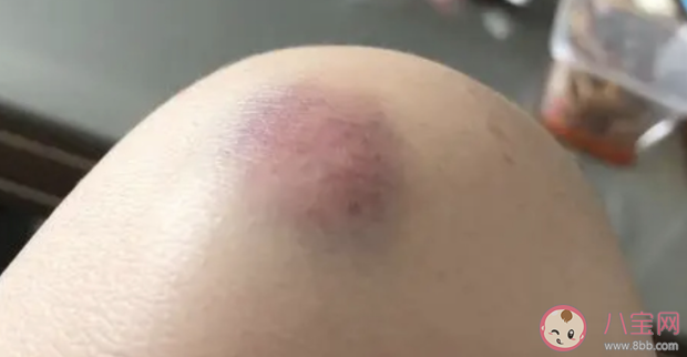 为什么你身上总有淤青 淤青应该怎么消除 为什么你身上总有淤青 淤青应该怎么消除