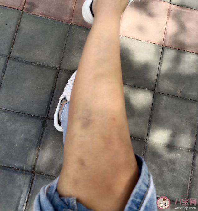 为什么你身上总有淤青 淤青应该怎么消除 为什么你身上总有淤青 淤青应该怎么消除