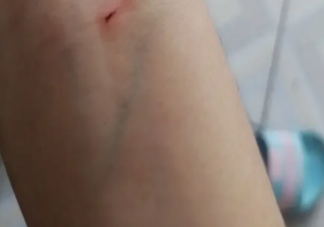 受伤了吹一吹有用吗 伤口愈合期为什么会很痒