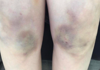 为什么你身上总有淤青 淤青应该怎么消除