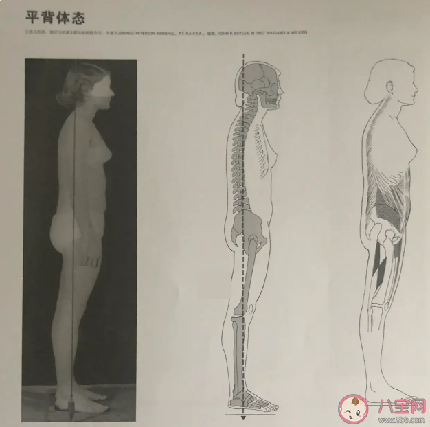 背部太直可能是平背综合征 平背有什么后果 背部太直可能是平背综合征 平背有什么后果