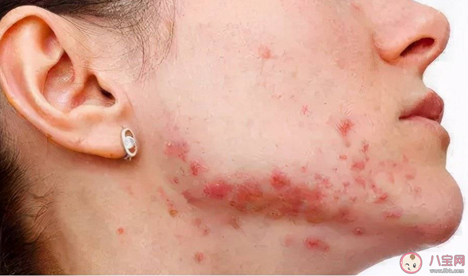 为什么来大姨妈会长痘 姨妈痘喜欢长在哪里 为什么来大姨妈会长痘 姨妈痘喜欢长在哪里