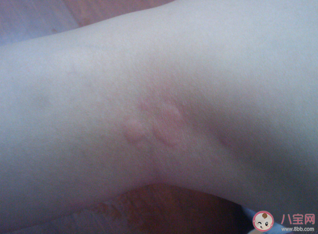 运动性过敏是怎么来的 运动性过敏有什么症状