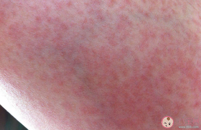 运动性过敏是怎么来的 运动性过敏有什么症状