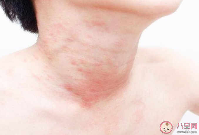 运动性过敏是怎么来的 运动性过敏有什么症状