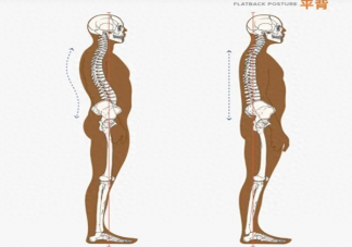 背部太直可能是平背综合征 平背有什么后果