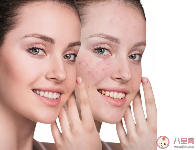 痘痘为什么会氧化变黑 这20个长痘原因你中了吗