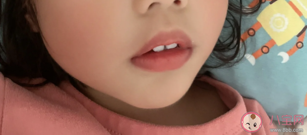 宝宝嘴巴有点外突是怎么回事 儿童为什么会出现龅牙