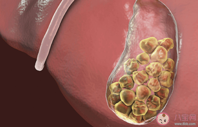 胆结石会不会变成癌 预防胆结石要多留意这4个方面 胆结石会不会变成癌 预防胆结石要多留意这4个方面