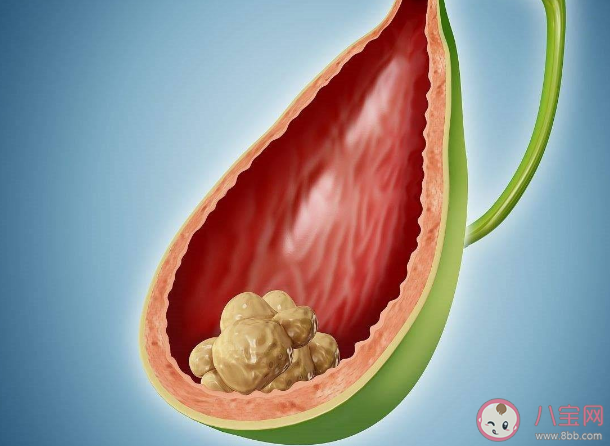 胆结石会不会变成癌 预防胆结石要多留意这4个方面 胆结石会不会变成癌 预防胆结石要多留意这4个方面