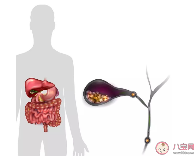 胆结石会不会变成癌 预防胆结石要多留意这4个方面 胆结石会不会变成癌 预防胆结石要多留意这4个方面