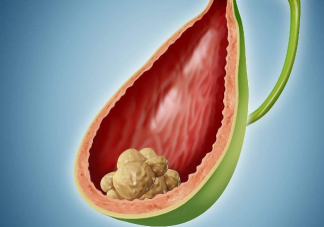 胆结石会不会变成癌 预防胆结石要多留意这4个方面