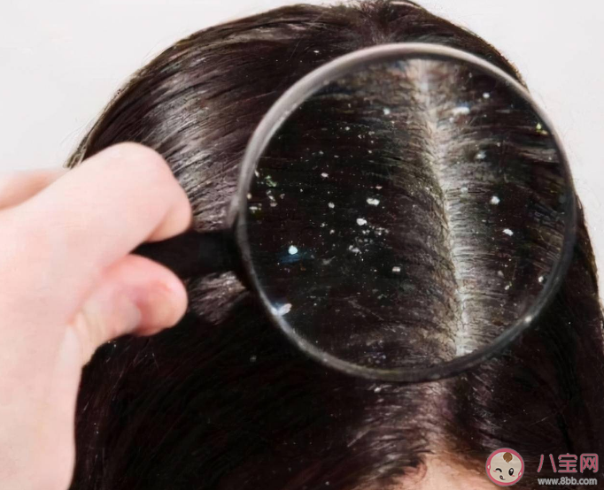 入秋之后为何头皮屑变多 头皮屑严重是什么原因