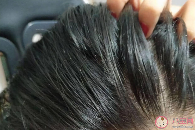 入秋之后为何头皮屑变多 头皮屑严重是什么原因