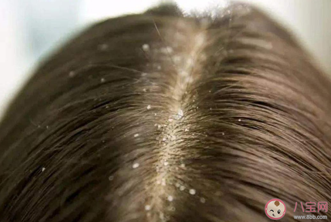 入秋之后为何头皮屑变多 头皮屑严重是什么原因