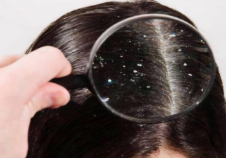 入秋之后为何头皮屑变多 头皮屑严重是什么原因