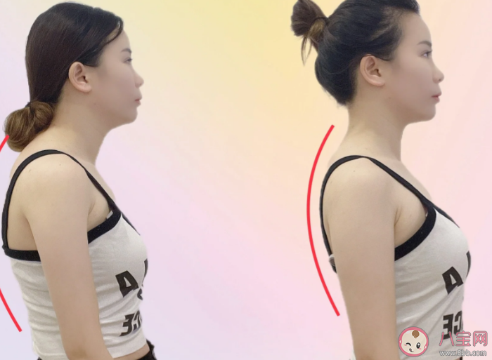 乌龟颈有什么危害 出现乌龟颈怎么办 乌龟颈有什么危害 出现乌龟颈怎么办