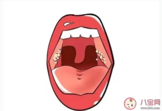 扁桃体也会长结石吗 如何预防扁桃体结石复发 扁桃体也会长结石吗 如何预防扁桃体结石复发