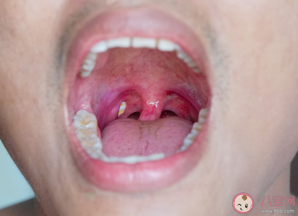 扁桃体也会长结石吗 如何预防扁桃体结石复发 扁桃体也会长结石吗 如何预防扁桃体结石复发