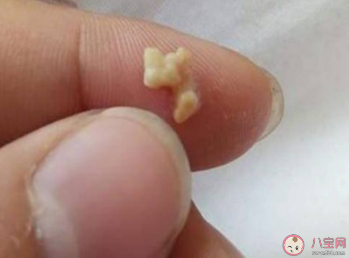 扁桃体也会长结石吗 如何预防扁桃体结石复发 扁桃体也会长结石吗 如何预防扁桃体结石复发