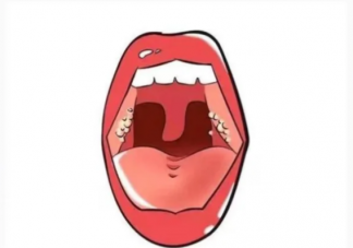 扁桃体也会长结石吗 如何预防扁桃体结石复发