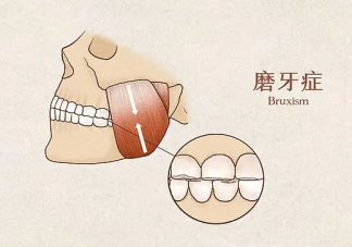 睡觉磨牙的原因有些 磨牙该怎么办
