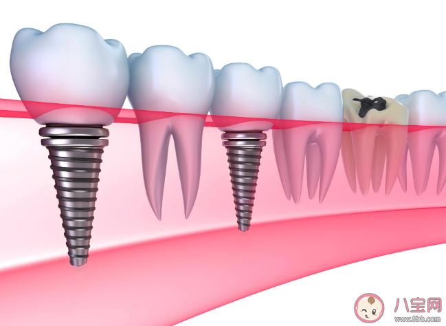 种植牙会干扰影像检查吗 种植牙松动了怎么办 种植牙会干扰影像检查吗 种植牙松动了怎么办