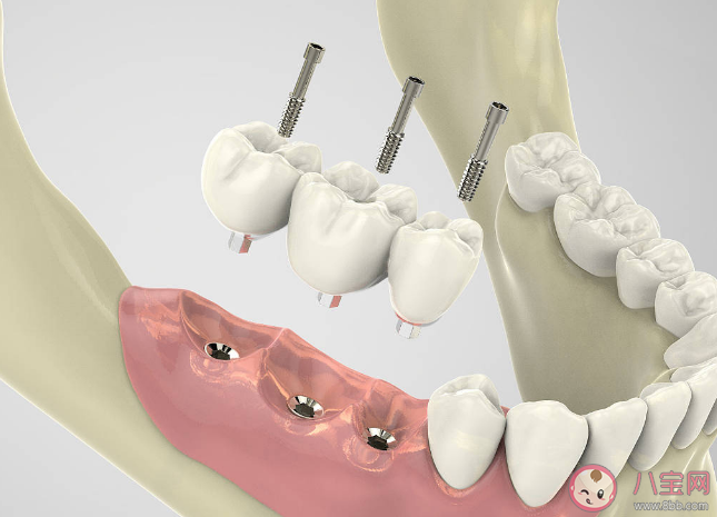 种植牙会干扰影像检查吗 种植牙松动了怎么办 种植牙会干扰影像检查吗 种植牙松动了怎么办