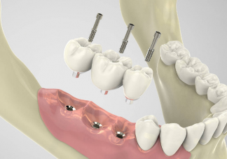 种植牙会干扰影像检查吗 种植牙松动了怎么办