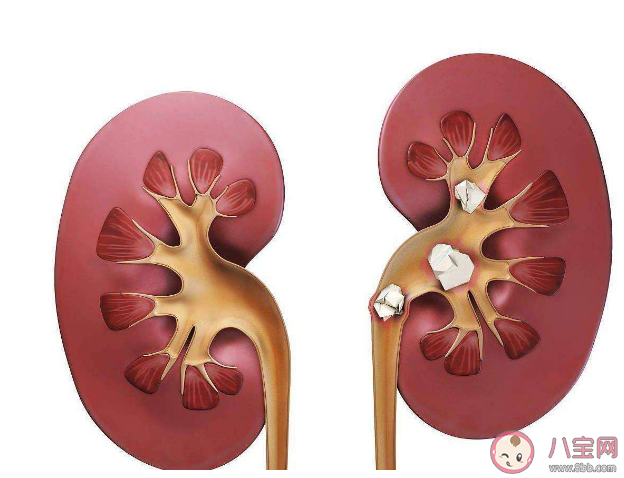 喝啤酒有利于体内结石排出吗 如何有效预防肾结石