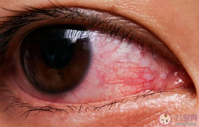 和红眼病人对视会被传染吗 家里有人得了红眼病怎么办