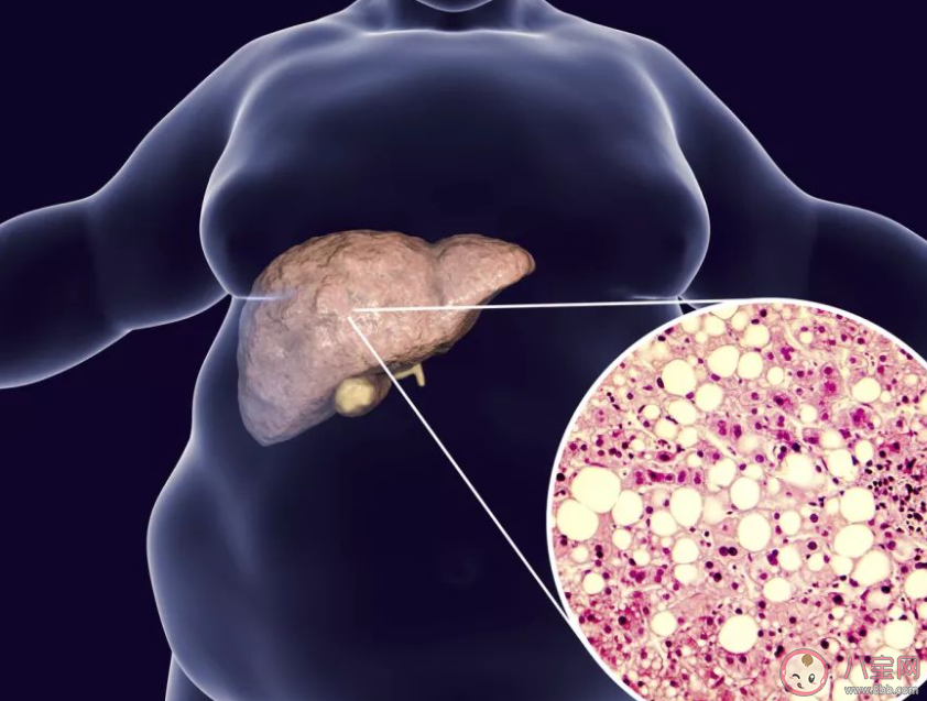 女子节食减肥减出脂肪肝是怎么回事 脂肪肝是如何产生的