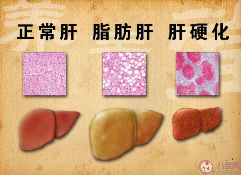 女子节食减肥减出脂肪肝是怎么回事 脂肪肝是如何产生的