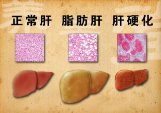 女子节食减肥减出脂肪肝是怎么回事 脂肪肝是如何产生的