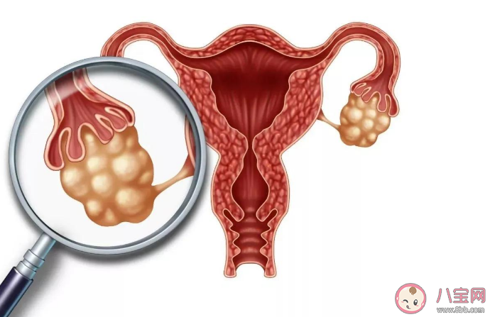 常喝咖啡会导致卵巢囊肿吗 患有卵巢囊肿会有感觉吗