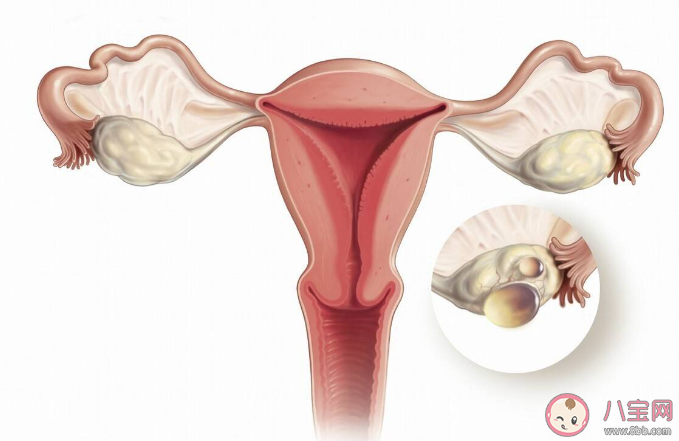 常喝咖啡会导致卵巢囊肿吗 患有卵巢囊肿会有感觉吗