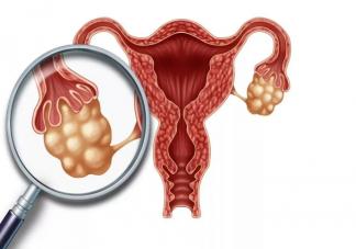 常喝咖啡会导致卵巢囊肿吗 患有卵巢囊肿会有感觉吗